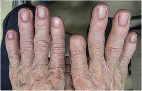 yellow nail syndrome following multiple