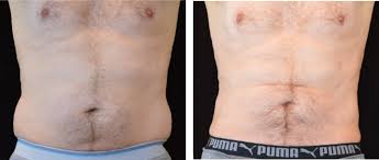 before and after liposuction of the abdomen and flanks