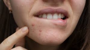 what causes lip acne and how you can