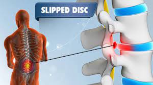treating slipped disc with homeopathy