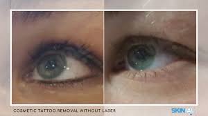 removal of eyelid and eyeliner skinial