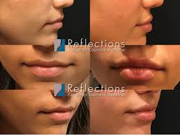 1cc restylane kysse for lips by dr