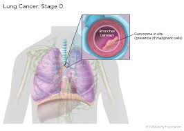Lung Cancer Staging Lungevity Foundation