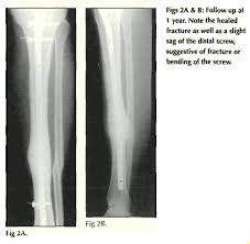 tibia fracture caused by a broken