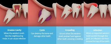 wisdom tooth extraction in singapore