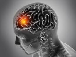 brain tumour causes symptoms and