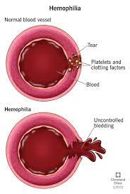 What Is Hemophilia?