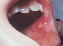 The bump can even be an extra tooth. What Causes Mouth Sores Oral Health Aspen Dental