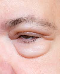 swelling around eye orbital swellings