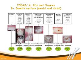 International Caries Detection And Assessment System Icdas
