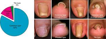 types of pincer nails cited from ref