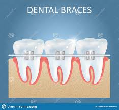 Dental Braces Vector Medical Poster Design Template Stock