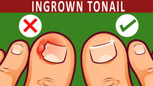 ingrown toenail naturally