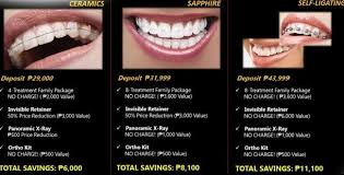 Braces with dental insurance cost. How Much Do Braces Cost In The Philippines Braces Cost How Much Braces Cost Orthodontics