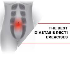 diastasis recti abdominis exercises