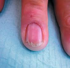 nails in systemic disease springerlink
