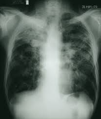 Doctors call this pulmonary fibrosis. Neumoconiosis De Los Trabajadores Del Carbon Trastornos Pulmonares Manual Msd Version Para Profesionales