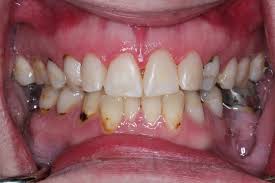 soda and acid erosion on teeth