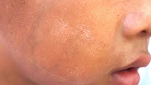 Trockene Haut Ursachen Tipps Und Pflege So Wird Ihre Haut Samtweich
