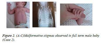 Poland syndrome is a birth defect characterized by an underdeveloped chest muscle and short webbed fingers on one side of the body. Poland Syndrome Two Cases Of New Borns With Left Sided Chest Defect And Dextrocardia