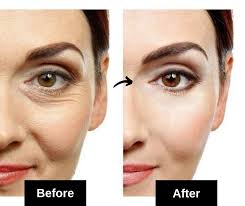 home remes for under eye wrinkles