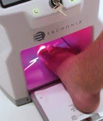 new lunula laser for fungus nails