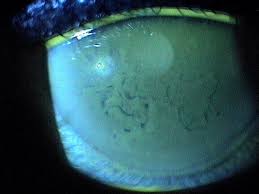 h18 59 anterior corneal dystrophies