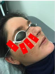 meibomian gland dysfunction therapy