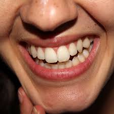 White spots on teeth, marks, patches or stains occur especially after whitening or braces in learn how to get rid of the white spots on your teeth using various treatments, including effective home generally, medical treatments are more reliable and stronger and, are used to get rid of severe white. What Are Those White Spots On My Teeth Houston Tx Latimer Dental Arts