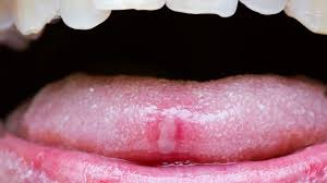 sore tongue 17 possible causes