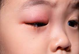 stye in child s eye types causes