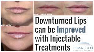 botox or cosmetic fillers