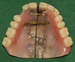 self repaired denture british dental