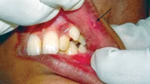 what causes lupus mouth sores or ulcers
