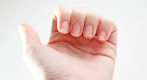 nail pitting causes and treatment ways