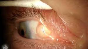 conjunctival inclusion cyst eyewiki