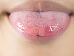 sore on the side of the tongue