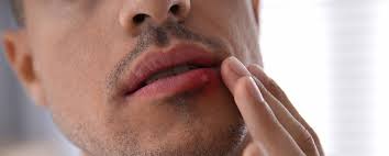 cold sores causes symptoms and treatments
