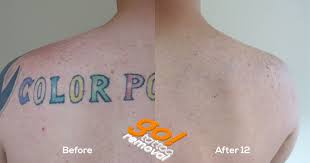 Much like many other tattoo removal methods, ipl can cause more harm than good when attempting to remove a tattoo from your skin. How Long Does It Take To Remove A Tattoo Go Tattoo Removal Allentown Pennsylvania