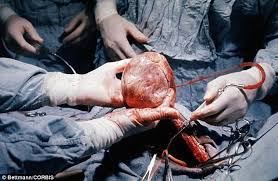 Image result for images of human organ for transplant
