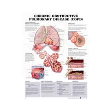 Anatomical Chronic Obstructive Pulmonary Disease Chart