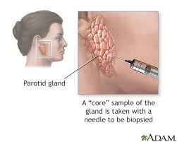 salivary gland biopsy information