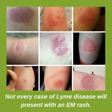 lyme disease uk a brief explanation