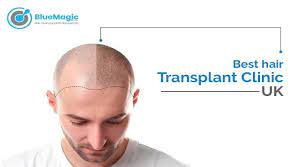 best hair transplant clinic uk hair