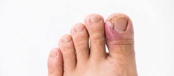 ingrown toenails nail surgery