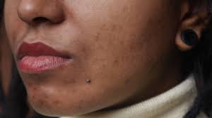 acne marks on dark skin