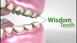 signs that your wisdom teeth