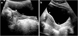 A pelvic ultrasound is a noninvasive diagnostic exam that produces images that are used to assess organs and structures within the female pelvis. Emergent Ultrasound Evaluation Of The Pediatric Female Pelvis Springerlink
