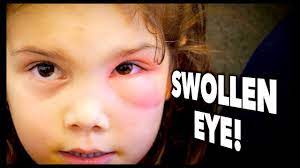 swollen eye periorbital cellulitis
