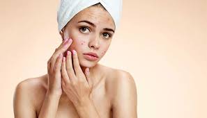 best acne treatment in delhi acne